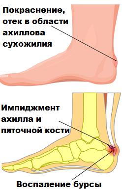 Ахиллесова Сухожилия Где Находится Фото